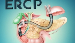 胆管结石困老妪 ERCP解顽疾   -毕节市三医开展首例“ERCP取石术”