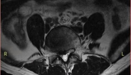 腿痛难行病在腰  微创镜下解顽疾 —毕节市三医“椎间孔镜微创手术”